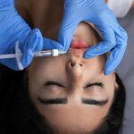 źle podany kwas hialuronowy w usta